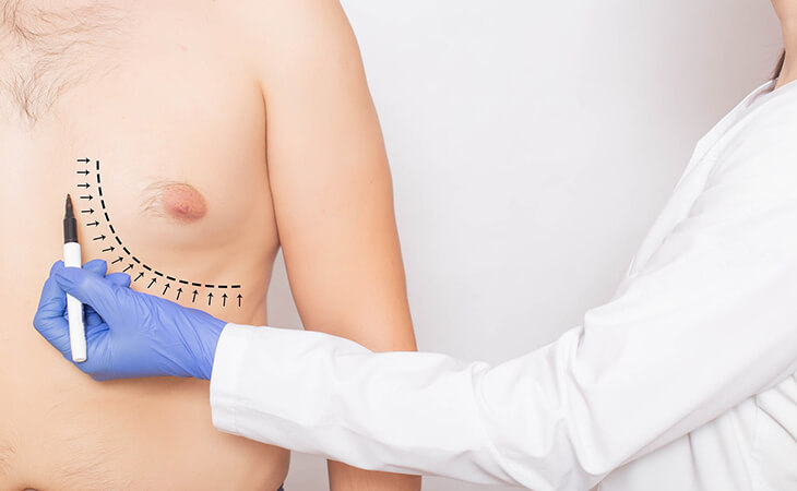 Gynecomastia In Thin Males, Dr Rajat Gupta