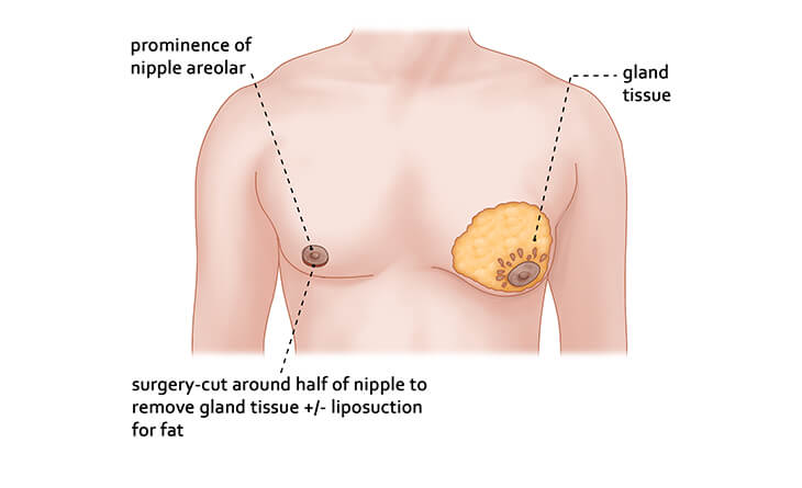 How Gynecomastia Glandular Tissue Removal is Done