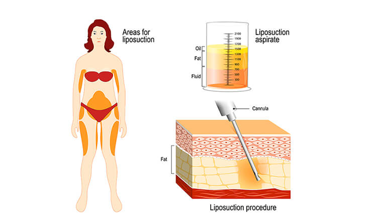liposuction surgery