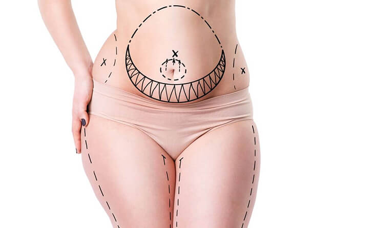 Where on your body can you get liposuction?