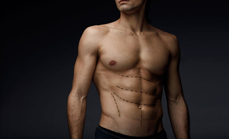 Can Men Benefit from Full Body Liposuction Surgery?