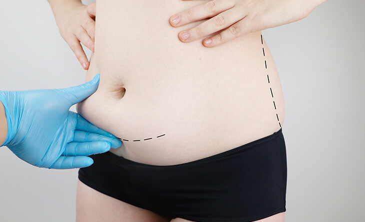 Tummy Tuck After C-Section