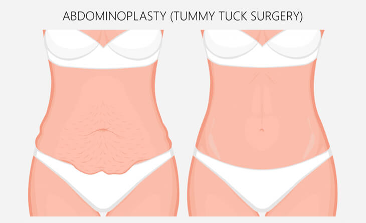 Tummy tuck surgery