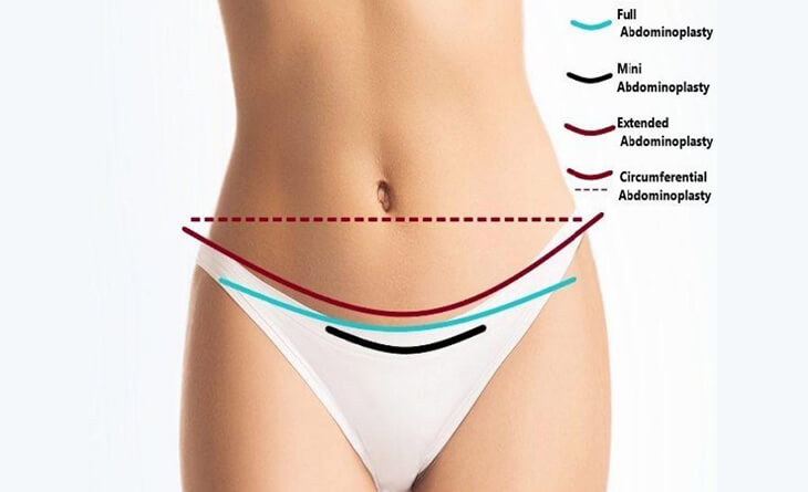 The Different Kinds of Tummy Tuck – Which One is Right for You?