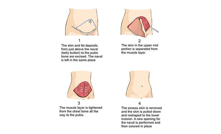 What are the Different Types of Tummy Tucks?