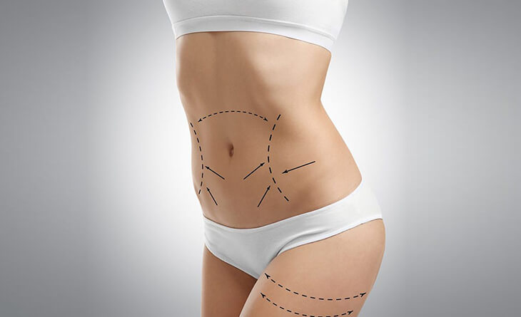 Mini Tummy Tuck (Partial Abdominoplasty): Procedure, Recovery Time, and  Cost - HubPages