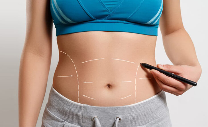 What is the Difference Between a Tummy Tuck & Abdominoplasty?