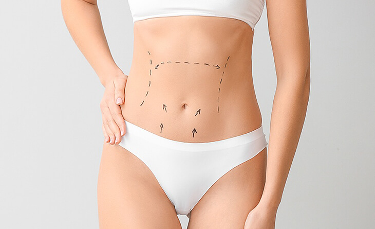 Mini Tummy Tuck Surgery in Delhi NCR India