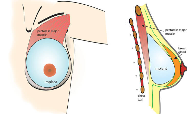 Chest Wall Tightness after Breast Augmentation.