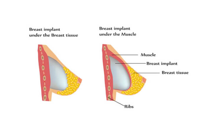 New technique in breast augmentation (Technical Reno)