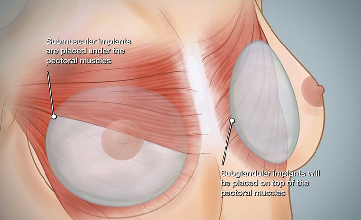 How Long is the Breast Augmentation Healing Time?