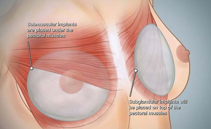 How Long is the Breast Augmentation Healing Time