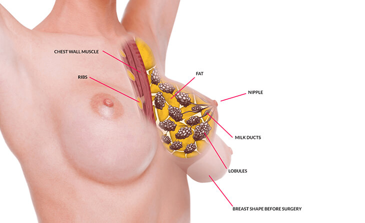 Mastopexy Surgery (Breast Lift), India- Surgery and Cost