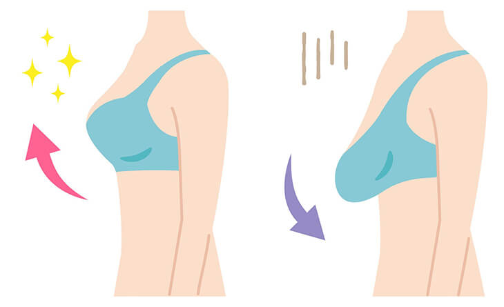 Is a Perfect Breast Lift Possible with Fillers? Dr Rajat Gupta