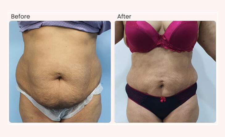 Reshaping Your Body with Liposuction Combined with Abdominoplasty - Dr.  Mohaghegh Plastic Surgeon, Sydney