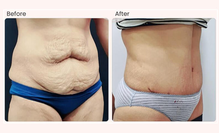 Tummy Tuck (Abdominoplasty) - Dr Anzarut Plastic Surgery