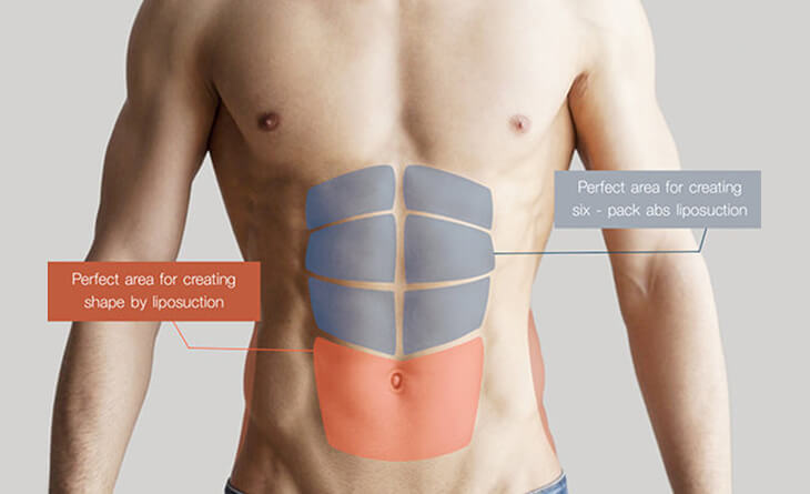 6 Pack Abs surgery