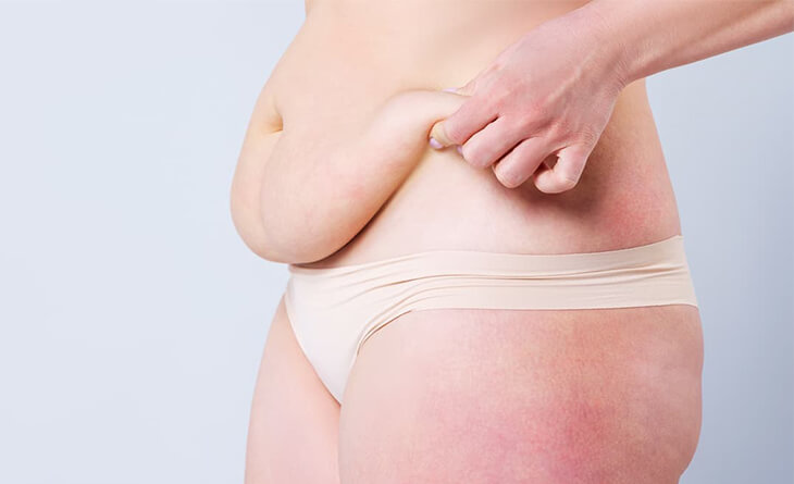 Tummy Tuck (Abdominoplasty): A Complete Overview - Dr. Donald A