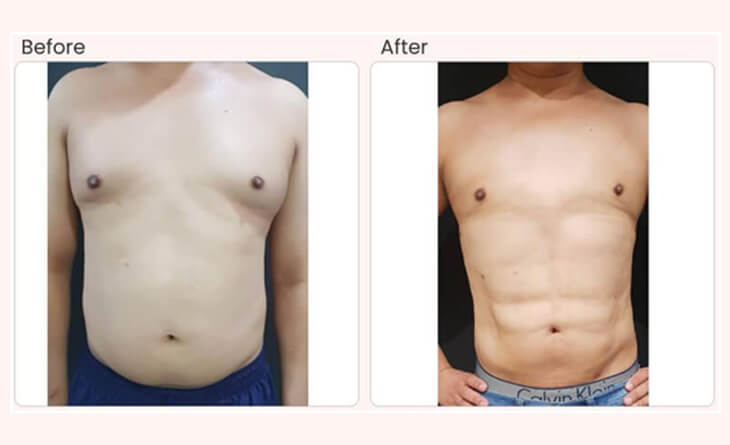 How I Learned to Cope With Gynecomastia and Thrive With Self