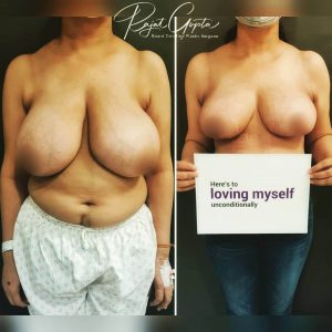 Breast Lift and Breast Reduction Dr Rajat Gupta - Before After Results - RG Aesthetics 912
