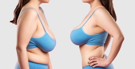Breast Reduction Surgery in India