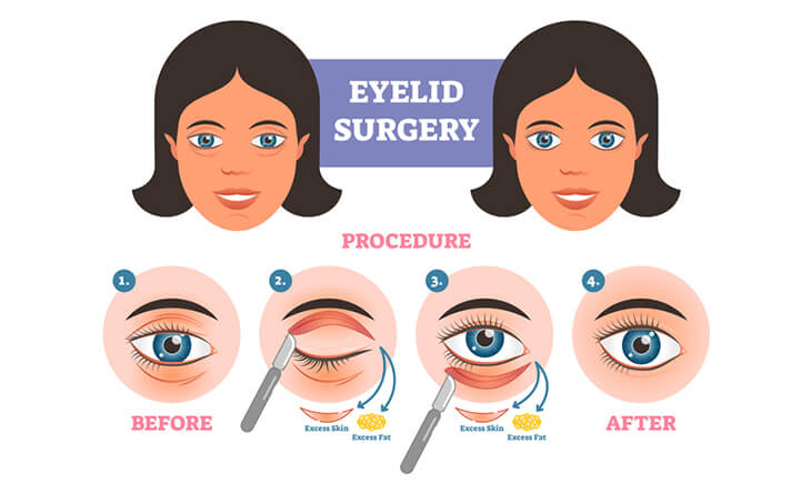 Upper Eyelids Blepharoplasty