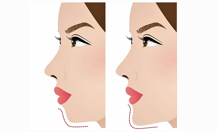 Chin augmentation surgery