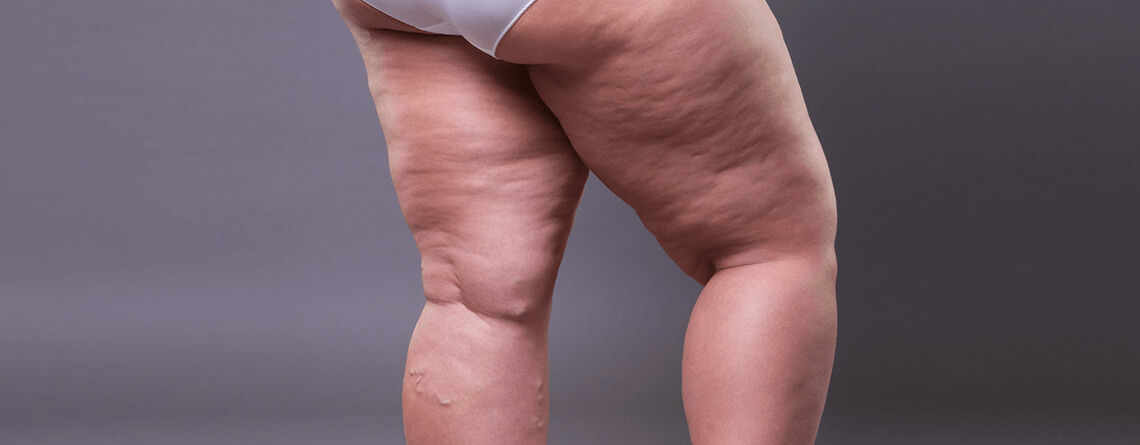 Liposuction for Cellulite