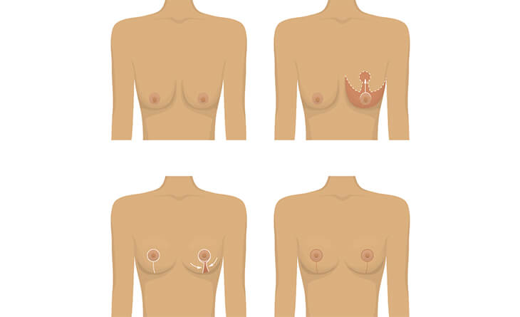 What to Expect After Breast Lift Surgery ? Best Plastic Surgeon in Delhi