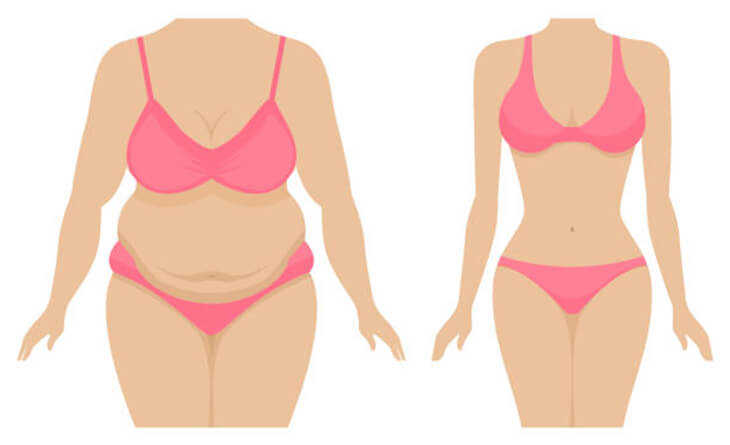 Liposuction Surgery in Delhi