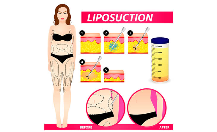 Liposuction procedure