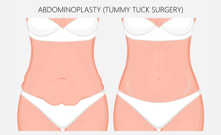 Tummy Tuck Procedure