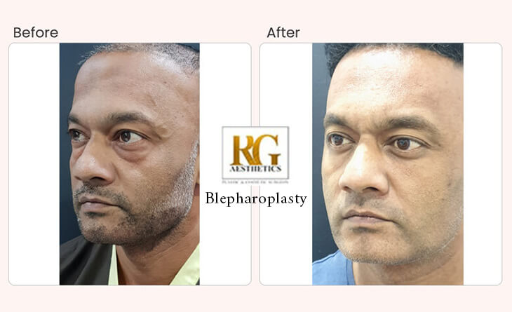 Blepharoplasty Surgery Procedure