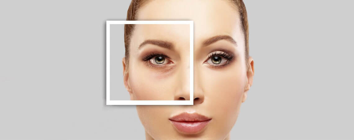 how-long-will-it-take-to-recover-from-blepharoplasty-eyelid-surgery