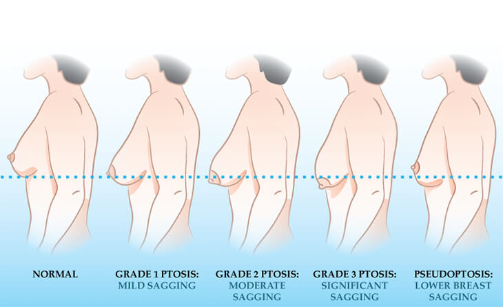 The normal breast – PlastSurgeon