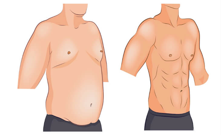 Male Breast Reduction Surgery