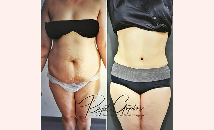 Tummy Tuck Surgery Before After Results