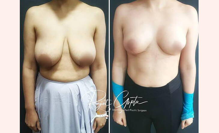 Breast Lift Before After Result - Breast Lift Treatment Delhi - Dr Rajat Gupta - 01