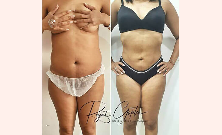 Liposuction Surgery Before After Result