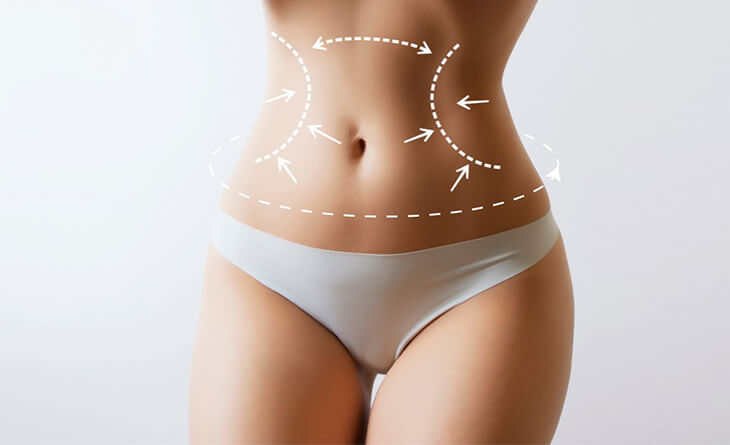 Liposuction procedure