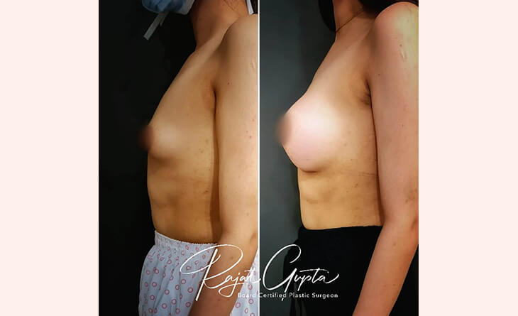 Breast Augmentation Before After Results - Breast Augmentation Procedure - Dr Rajat Gupta Plastic Surgeon
