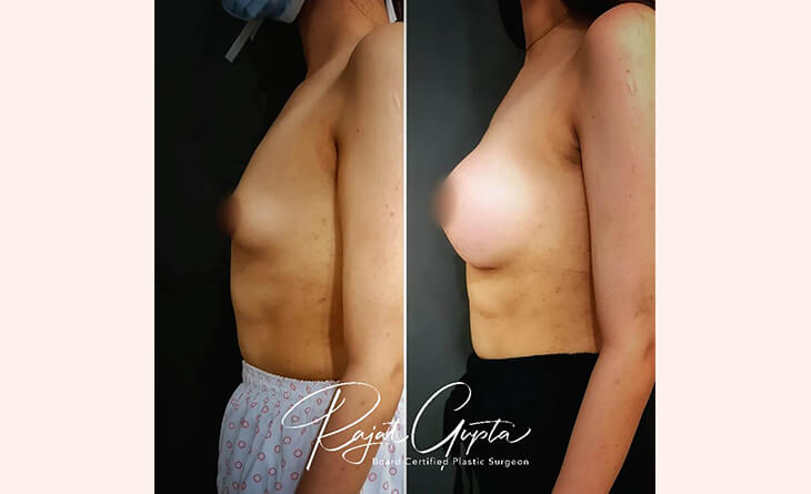 Best Celebrity Breast Augmentation Surgeon