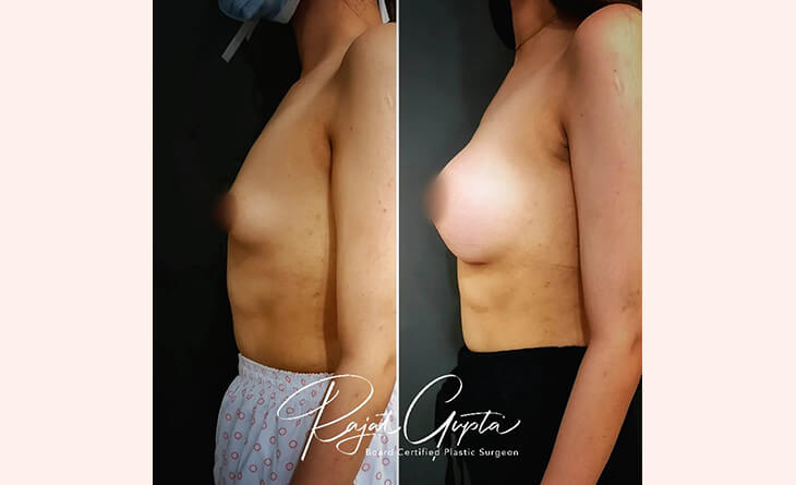 Breast Augmentation Procedure