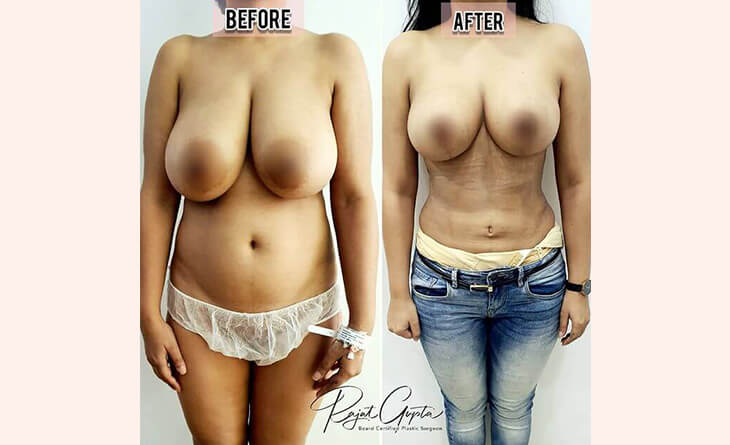 Breast Reduction Before After Results