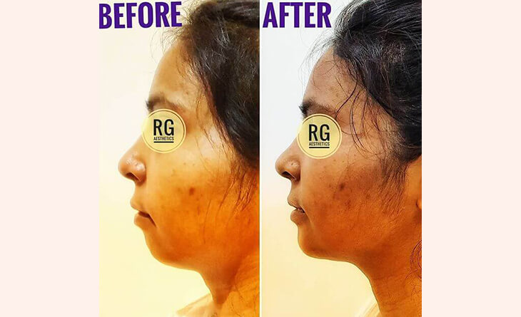 Chin Augmentation Before After Results