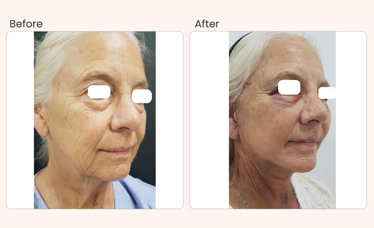 Facelift Before & After