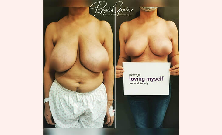 Breast-Lift-and-Breast-Reduction Before After Results