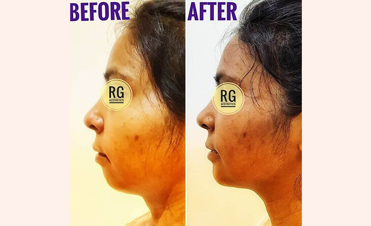 Chin Augmentation Before After Results- Chin Augmentation Procedure - Dr Rajat Gupta - Best Plastic Suregon in Delhi