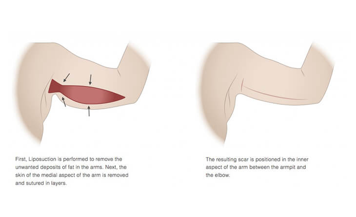 Bust and arms girdle brachioplasty liposuction, K1 (18-21 mmHg)