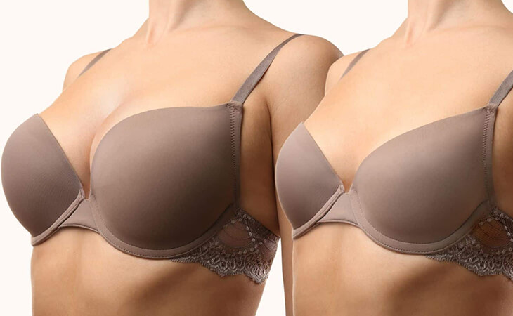 Breast reduction surgery procedure